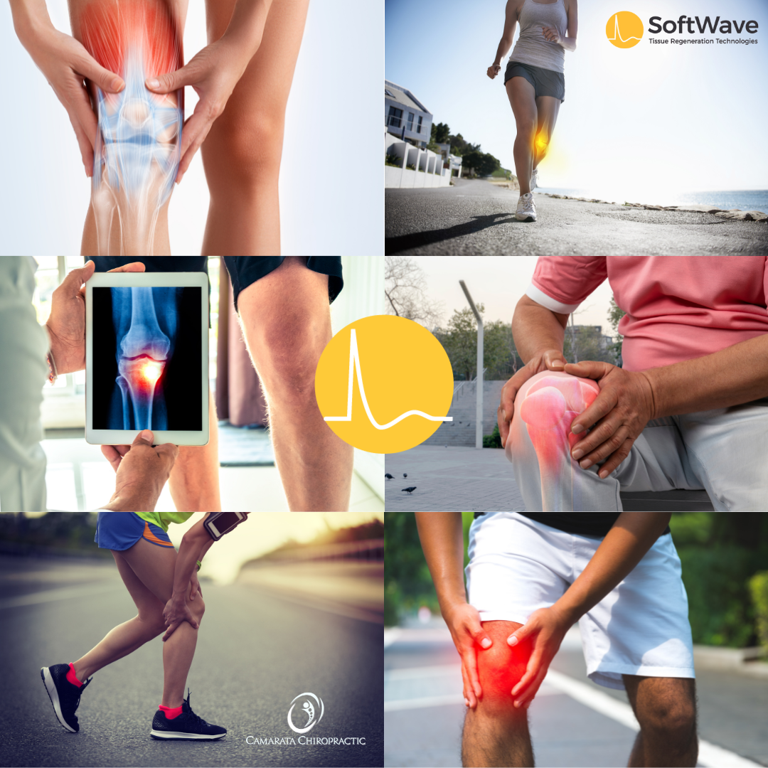 Looking to Avoid Knee Surgery?: Discover the Power of SoftWave Therapy at Camarata Chiropractic & Wellness in Rochester, NY