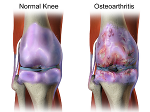 How Does SoftWave Therapy Compare to Other Treatments for Knee Pain?